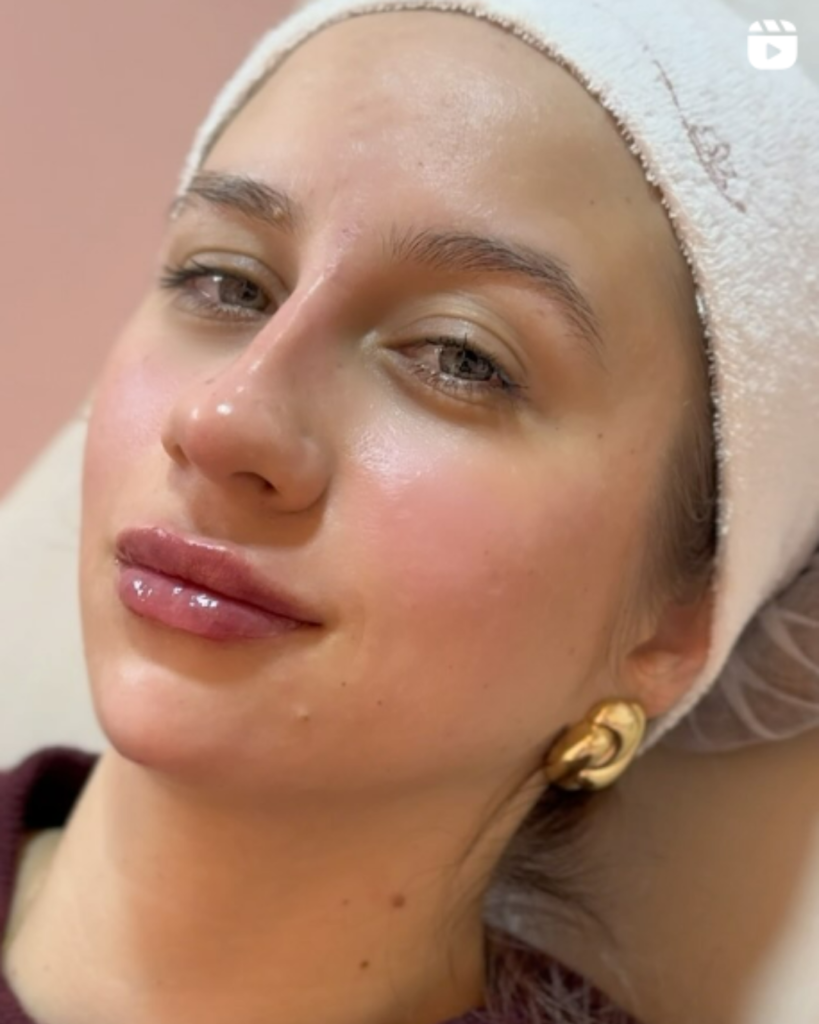 HARMONIZAÇÃO FACIAL
